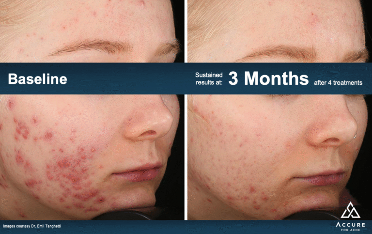 Rezultate tratament laser acnee – preț Clinica Asterium